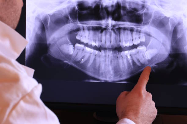 Best Emergency Dentist for Lost Fillings or Crowns in Lexington, SC