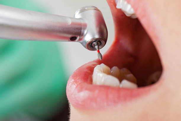 Best Emergency Dentist for Knocked-Out Tooth in Lexington, SC